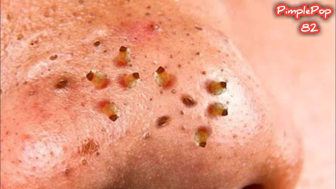 Satisfying Videos | Pimples Popping – Blackheads – Acne & Cysts Compilation #82