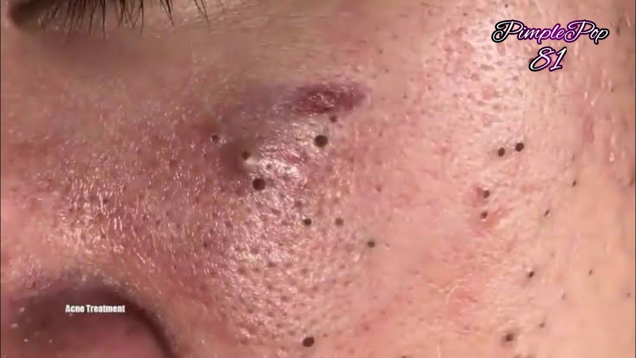 Satisfying Videos | Pimples Popping – Blackheads – Acne & Cysts Compilation #81