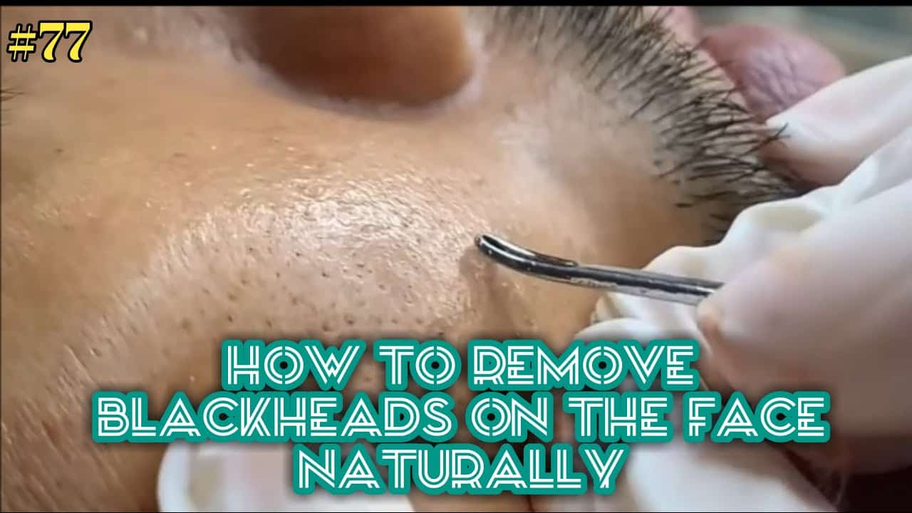 Satisfying Videos | Pimples Popping – Blackheads – Acne & Cysts Compilation #77