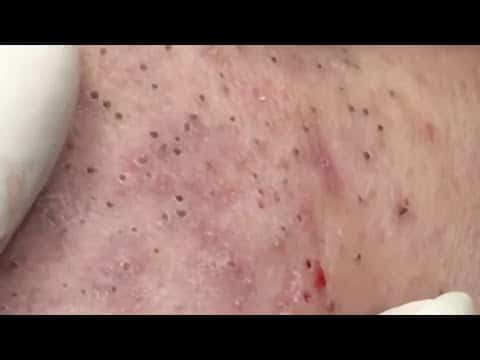 Satisfying Videos | Pimples Popping – Blackheads – Acne & Cysts #114