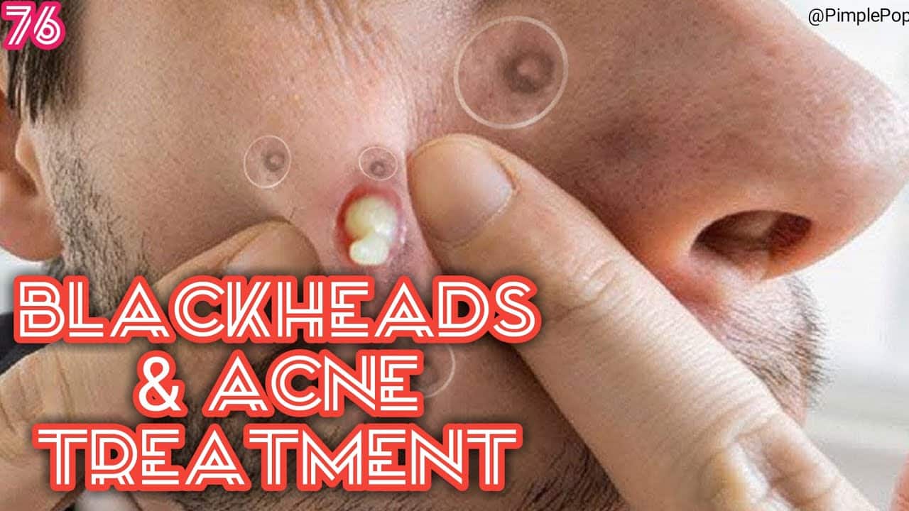 Satisfying Videos | Pimples Popping – Blackheads – Acne & Cysts Compilation #76