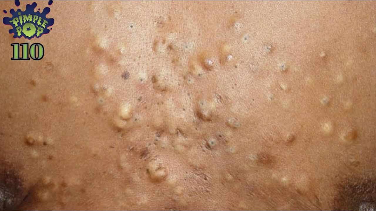 Satisfying Videos | Pimples Popping – Blackheads – Acne & Cysts Compilation #110