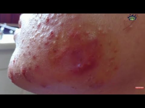 Satisfying Videos | Pimples Popping – Blackheads – Acne & Cysts Compilation #119