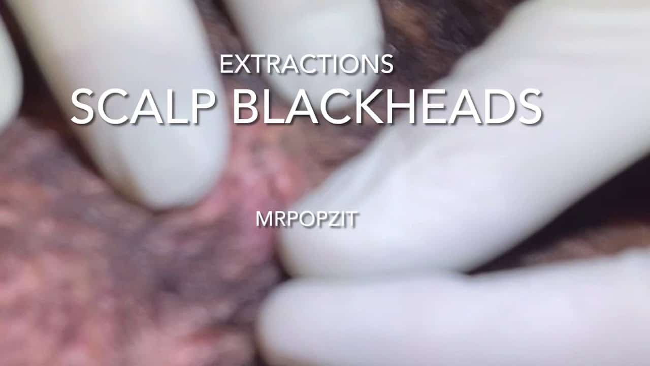 Scalp blackhead removal. Cluster of plugs. Blackhead extractions on scalp. Clogged pores. MrPopZit.