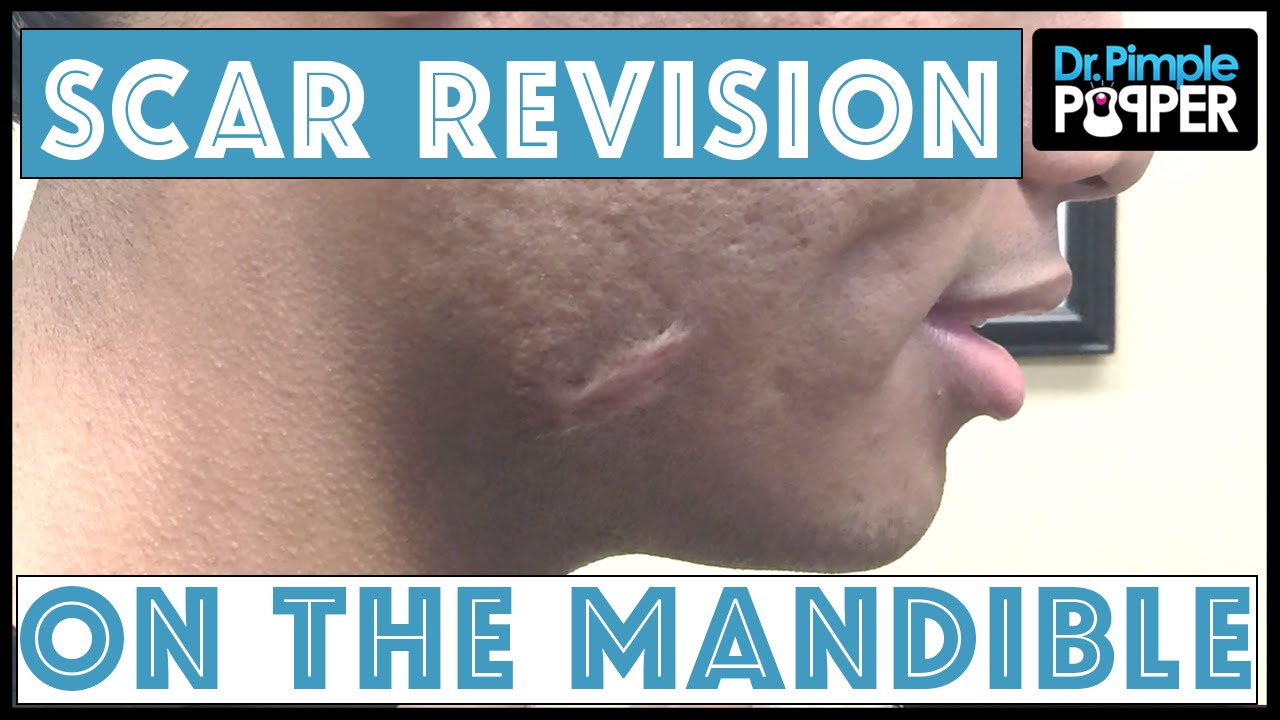 Scar Revision on Right Mandible