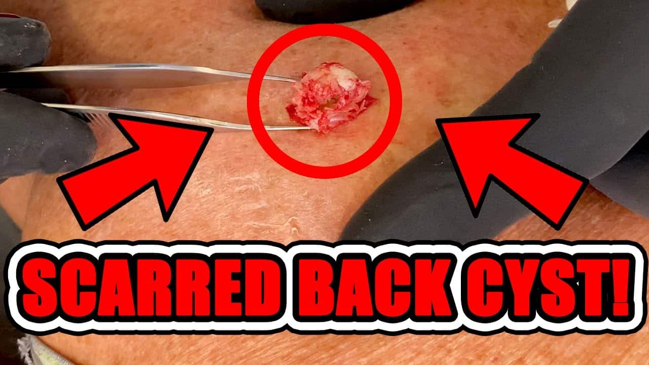 SCARRED BACK CYST!