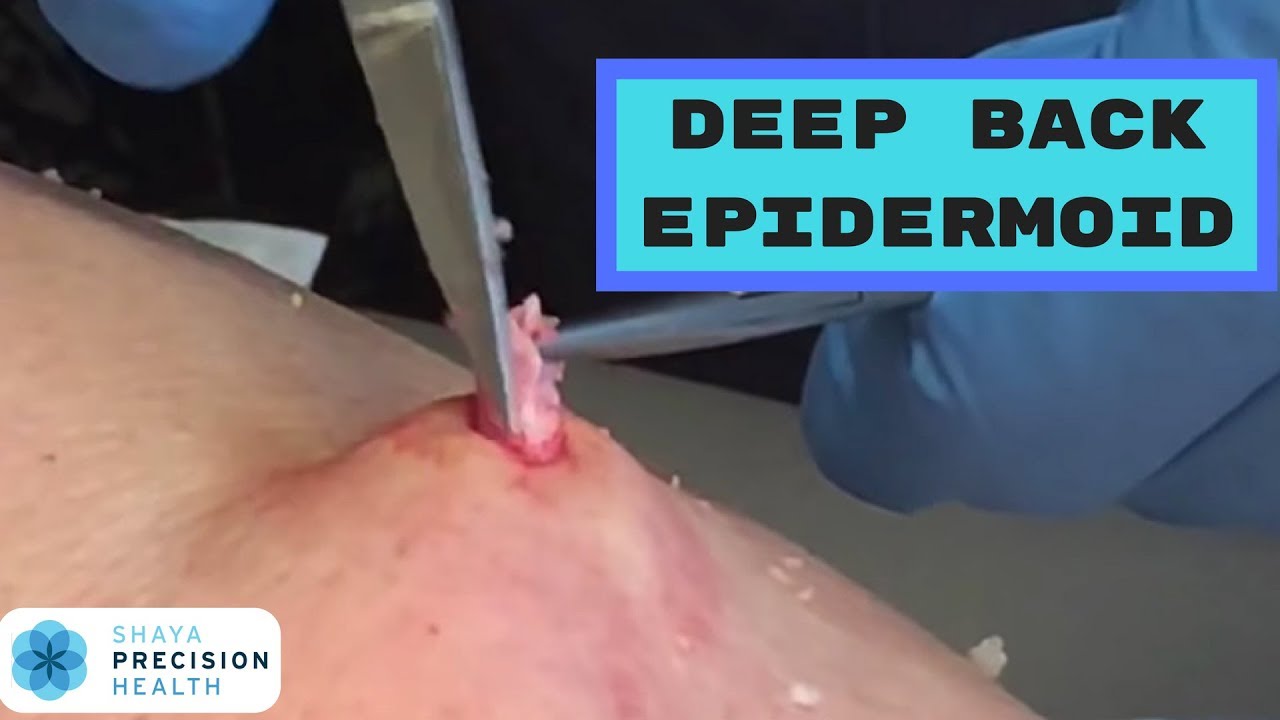Sebaceous cyst/epidermoid cyst removal by Dr. Shaya