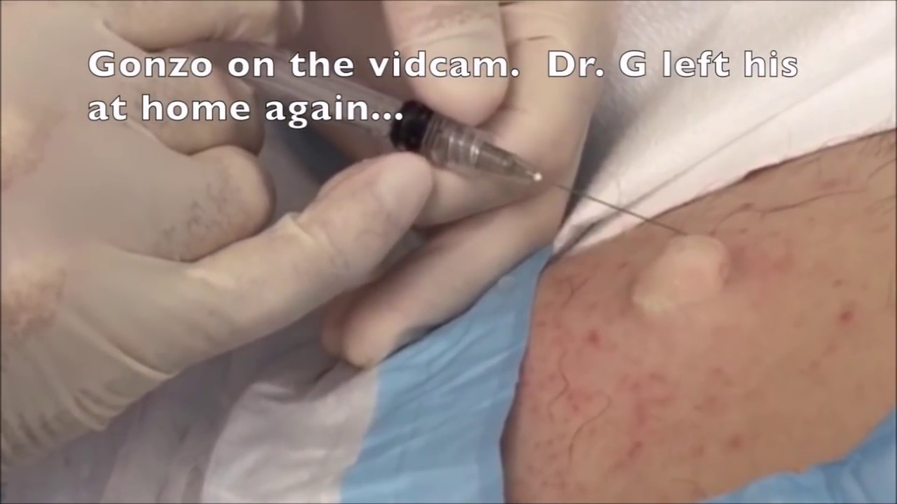Sebaceous Cyst Excision! Bonus Growth Removal & Popping