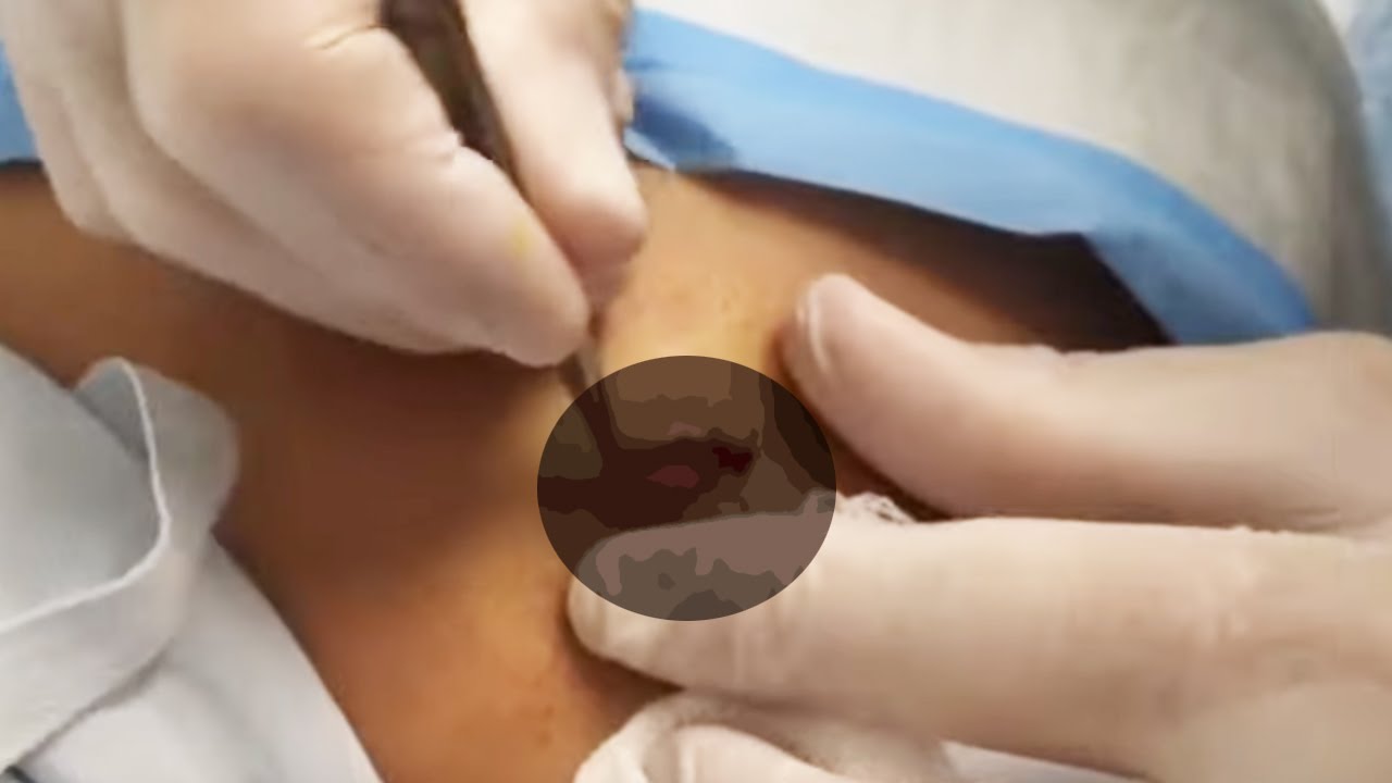 Sebaceous Cyst on Back | Dr. John Gilmore