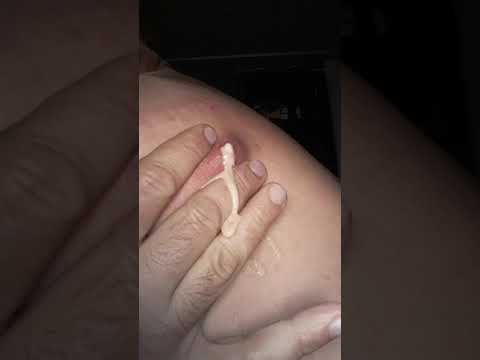 Sebaceous cyst popping