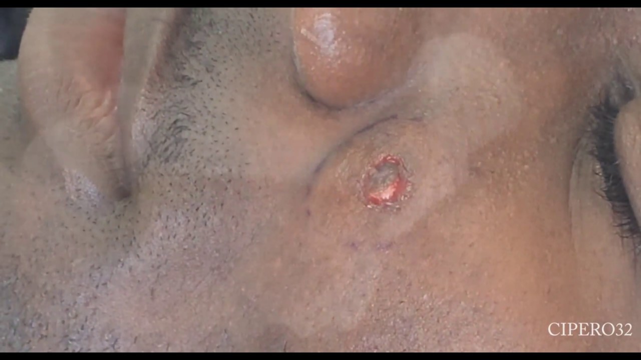 Sebaceous Cysts Removal – Face