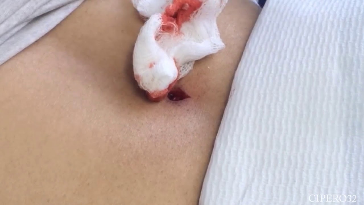 Sebaceous Cysts Removal lower back