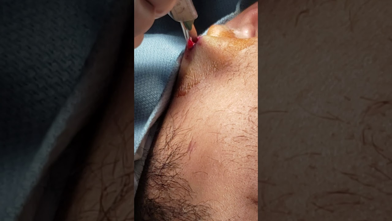 Sebaceous cysts removed from cheek l