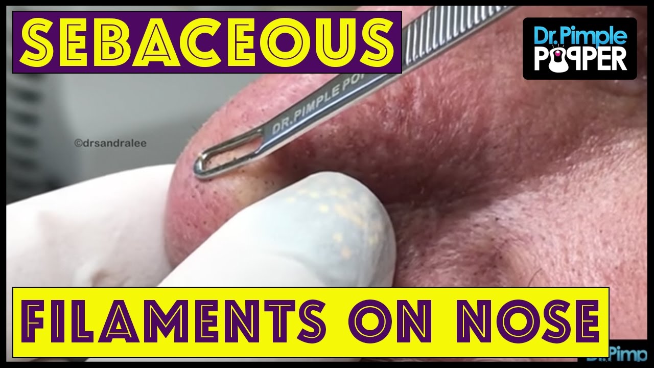 Sebaceous Filaments Extracted on the Nose