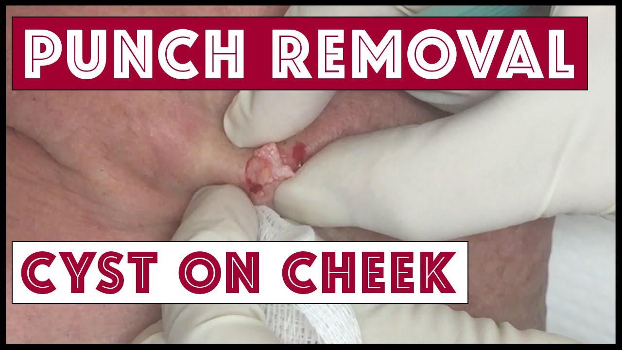 Second try cyst excision: Punch biopsy tool used