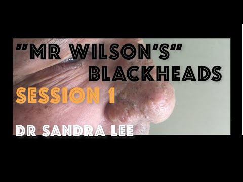 Session 1: "Mr Wilson" Extracting large blackheads on the nose