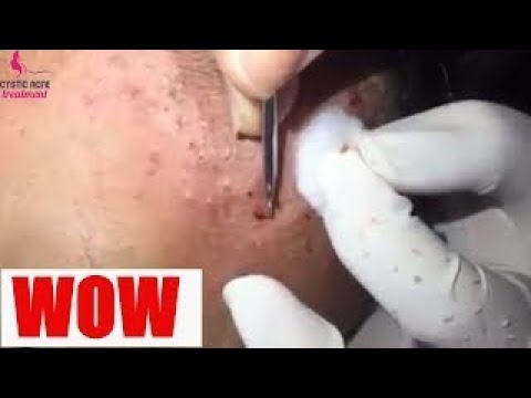 Severe acne & Whitehead Removal Cyst Pimple Popping 755