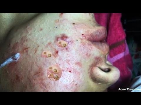 Severe Cystic Acne & Blackhead Removal – Cyst Pimple Popping 2017 (Part 30)