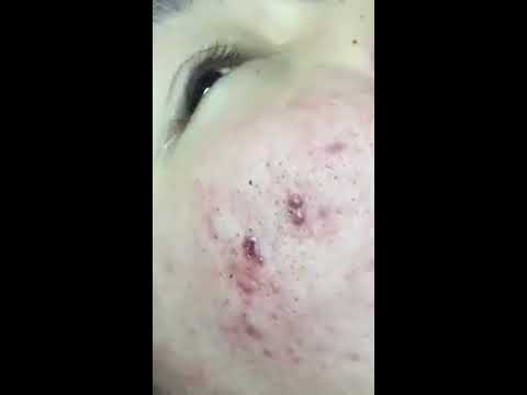 Severe Cystic Acne – Thanh Truc Spa: Cyst Pimple Popping