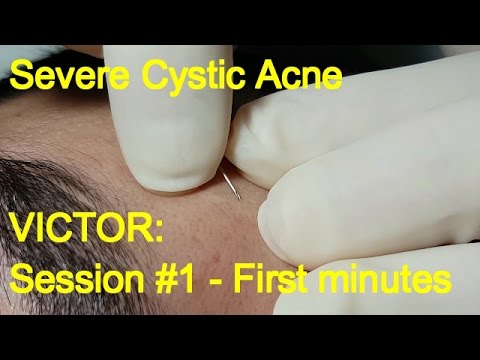 Severe Cystic Acne – Victor: First minutes (Session #1)