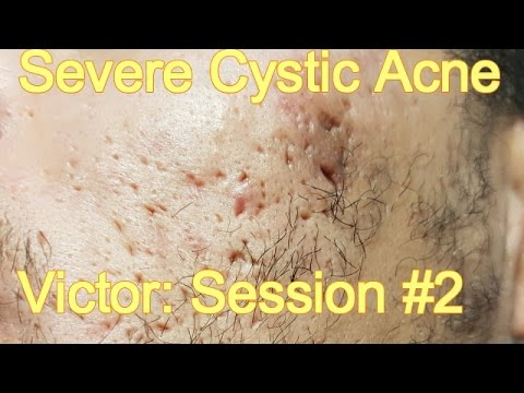 Severe Cystic Acne – Victor: Session #2
