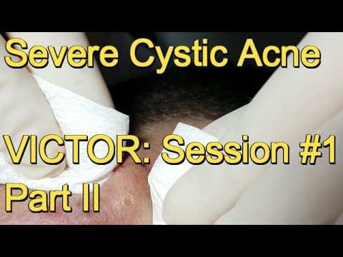 Severe Cystic Acne – VICTOR:  Session #1  Part II