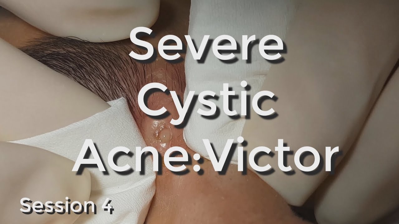 Severe Cystic Acne – Victor: Session #4