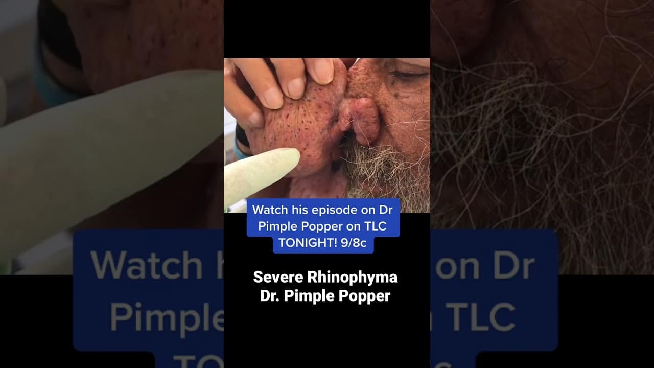 Severe Rhinophyma! Have you watched this episode on TLC? #drpimplepopper #shorts
