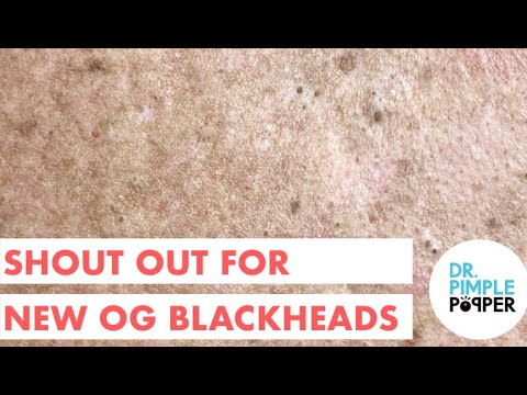 Shout Out for NEW OG Blackheads!