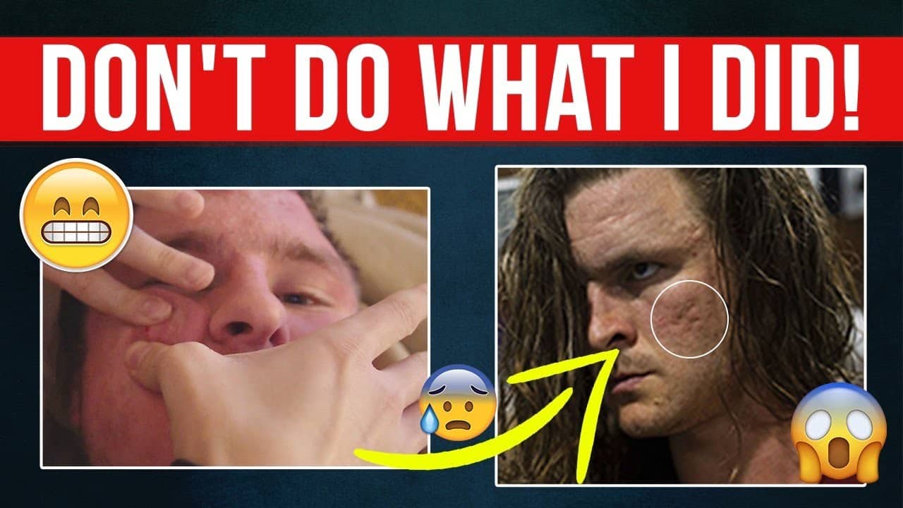 SHOWING MY BIGGEST PIMPLE POPS | The Worst Thing I Ever Did!