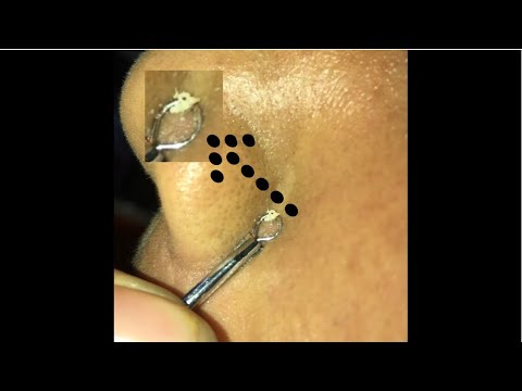 Side nose pimple popping/侧鼻疙瘩突然爆裂