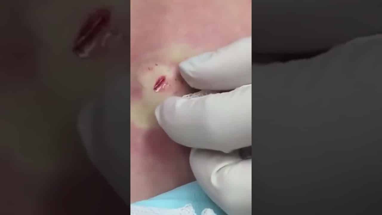 Simply irre-cyst-ible! #shorts #youtubepartner #drpimplepopper #popaholics #cyst