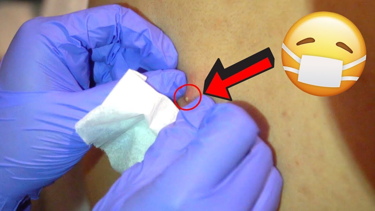 SISTER POPS MY BACK CYST! **graphic**