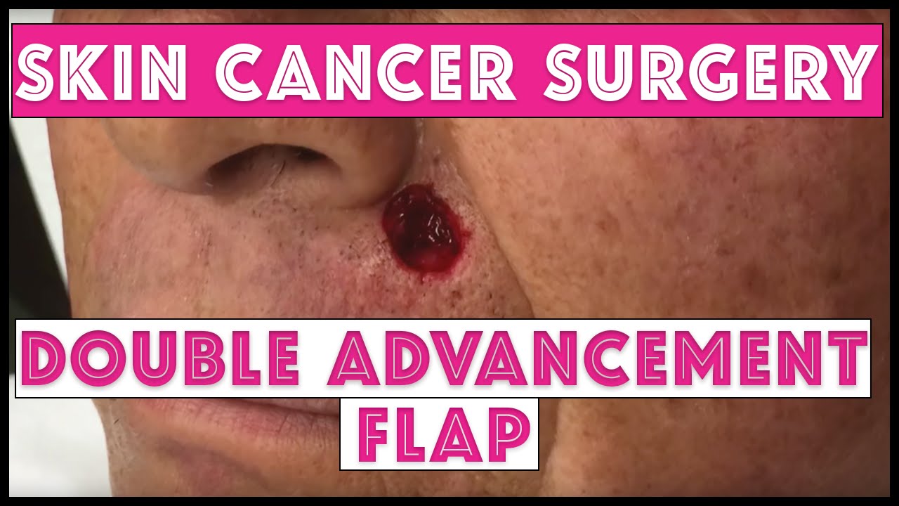 Skin cancer surgery: Double Advancement Flap on upper lip