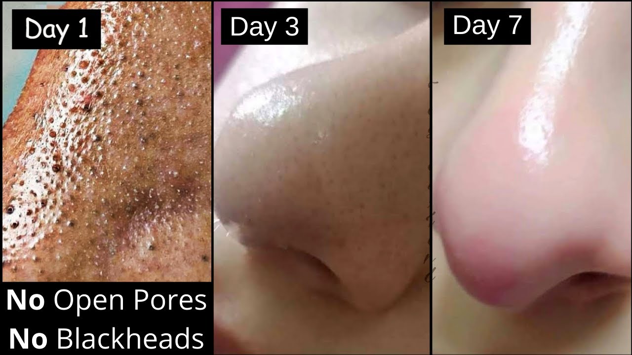 Skin चमकेगी| नाक, Cheeks से Clogged Pores, Blackheads, Whiteheads जड़ से खत्म करे सिर्फ 1 हफ्ते मे|