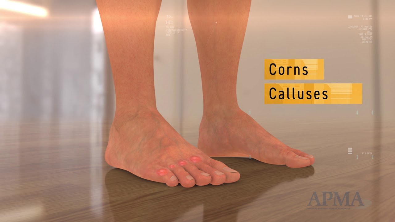 Skin Disorders of the Foot