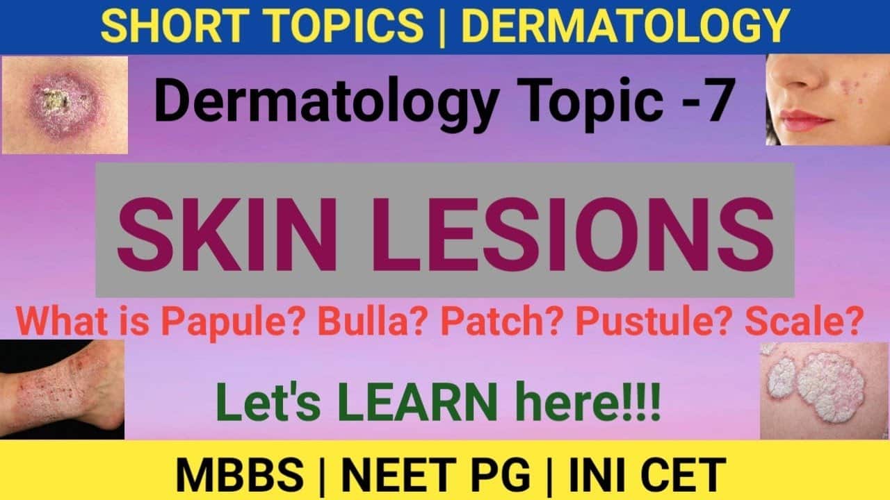 SKIN LESIONS | PAPULES| PUSTULE| CRUST | BULLA | Dermatology Topic 7 | MBBS | NEET PG 2022