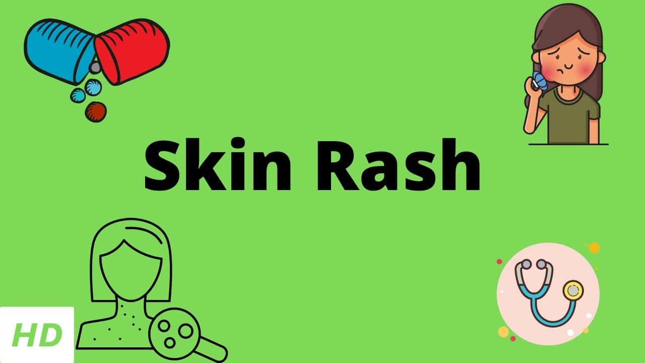 Skin Rash, Causes, Signs and Symptoms, Diagnosis and Treatment.