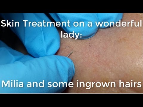 Skin Treatment on a Wonderful Lady