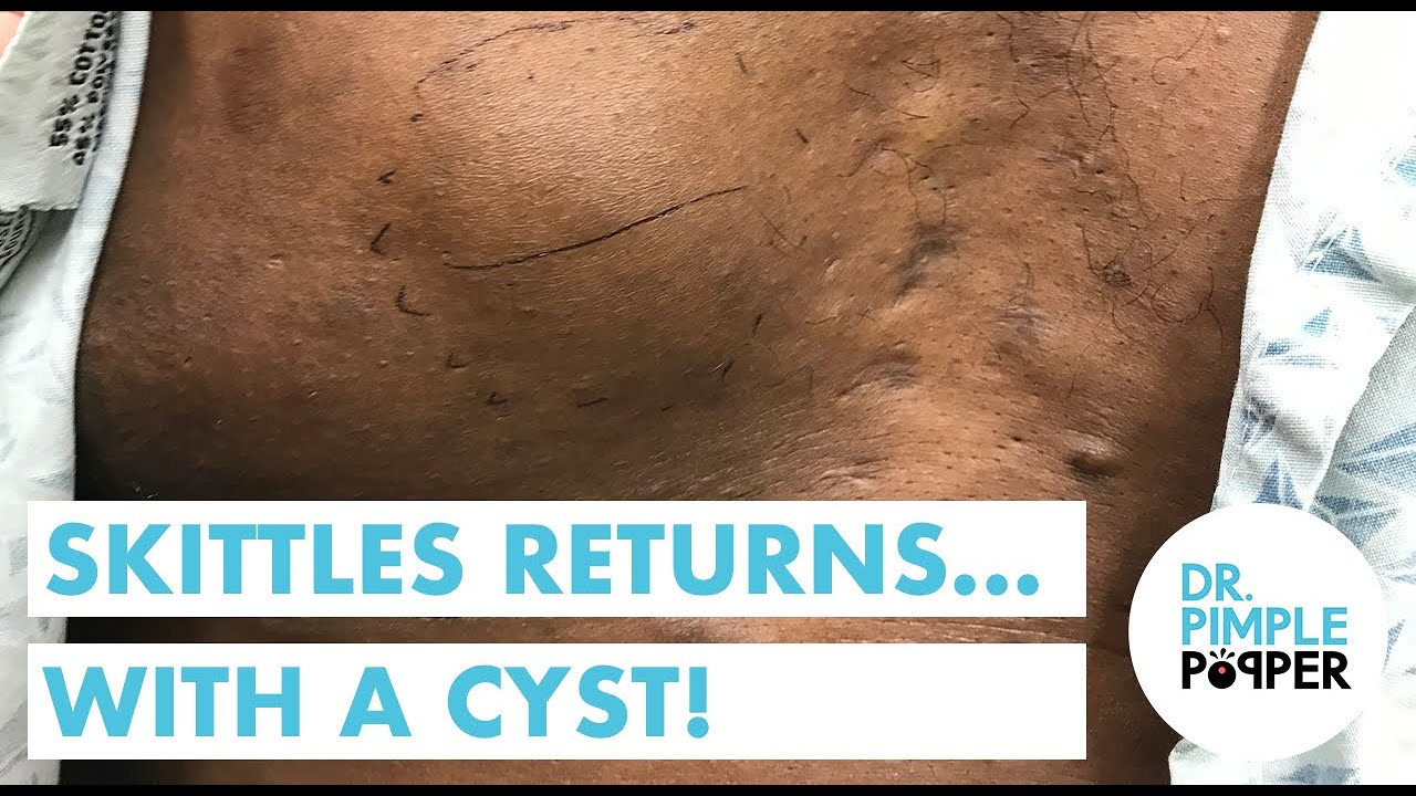 Skittles Returns with a Big Cyst!