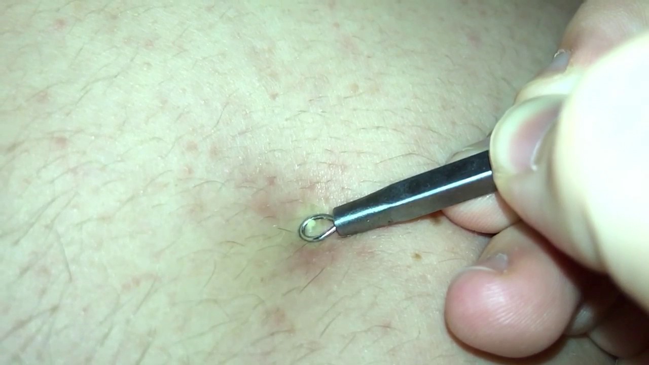 SLOW MOTION SATISFYING PIMPLE POP!!