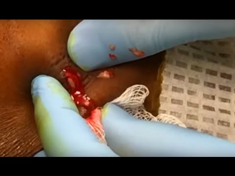Small Abscess Drained – Cysts, Pimples & Popping!