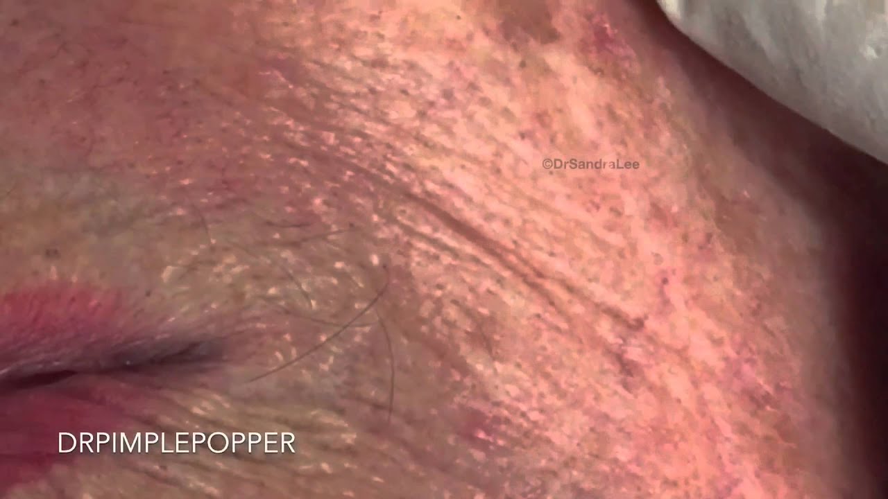 Small blackheads extracted. Happy Humpday Bumpday!  For medical education- NSFE
