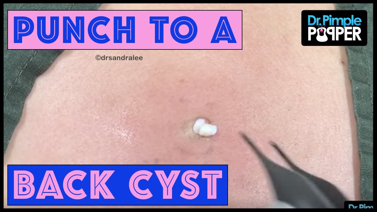 Small but Mighty Annoying Epidermoid Cyst