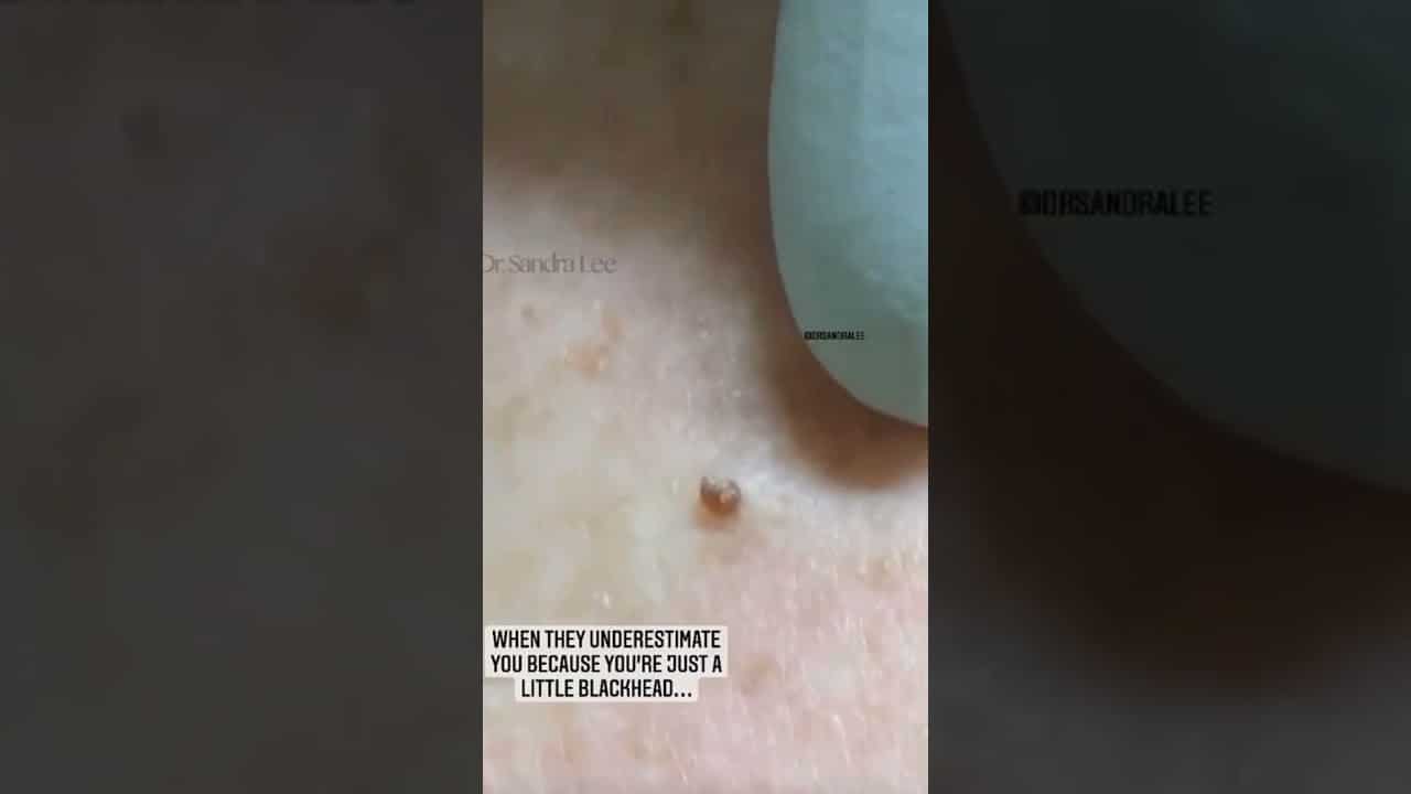 Small BUT Mighty Blackhead | Dr. Pimple Popper #shorts #youtubeshorts #pimple #blackhead #popping