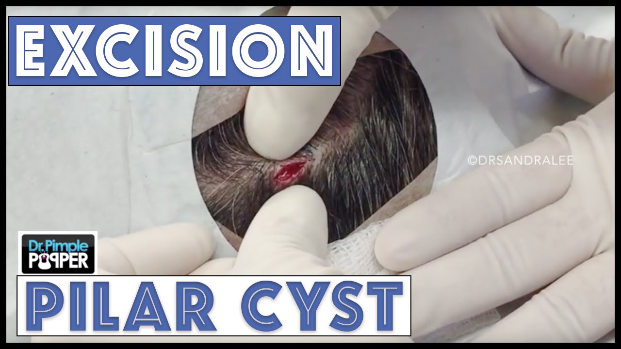 Small cyst on the scalp popped out surgically