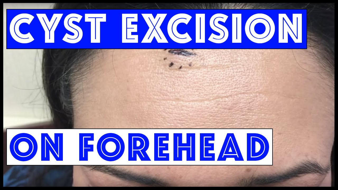 Small cyst, previously inflamed and squeezed, excised completely