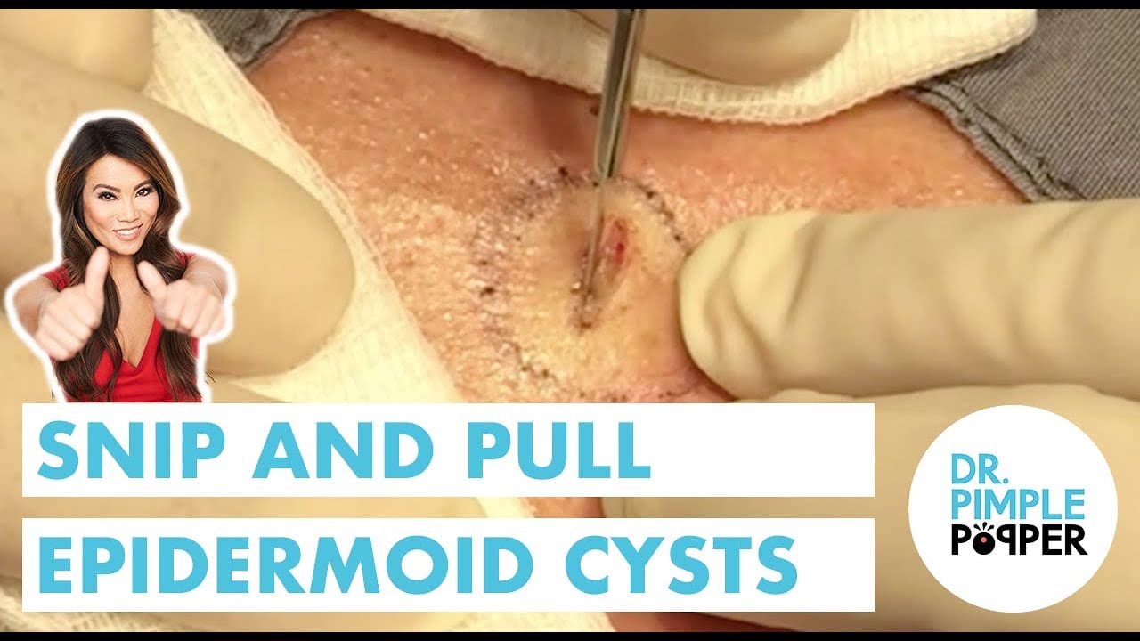 Snip and Pull Epidermoid Cysts (x2)