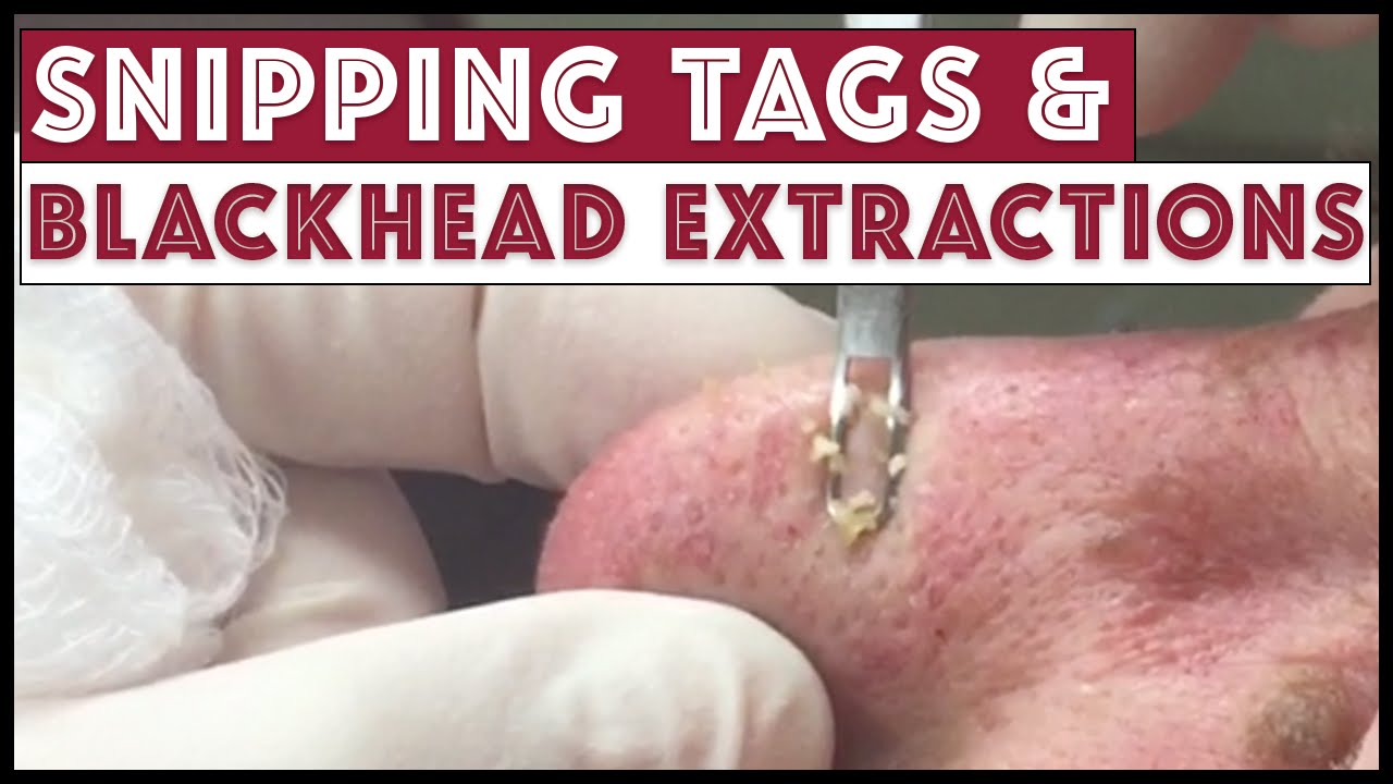 Snipping Tags and Blackhead Extractions