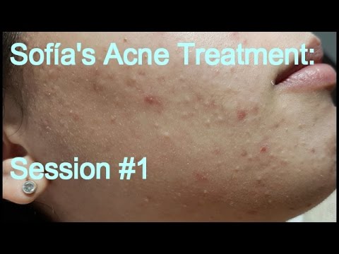 Sofia’s Acne Treatment: Session #1